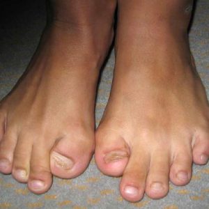 Toes of person with FOP 